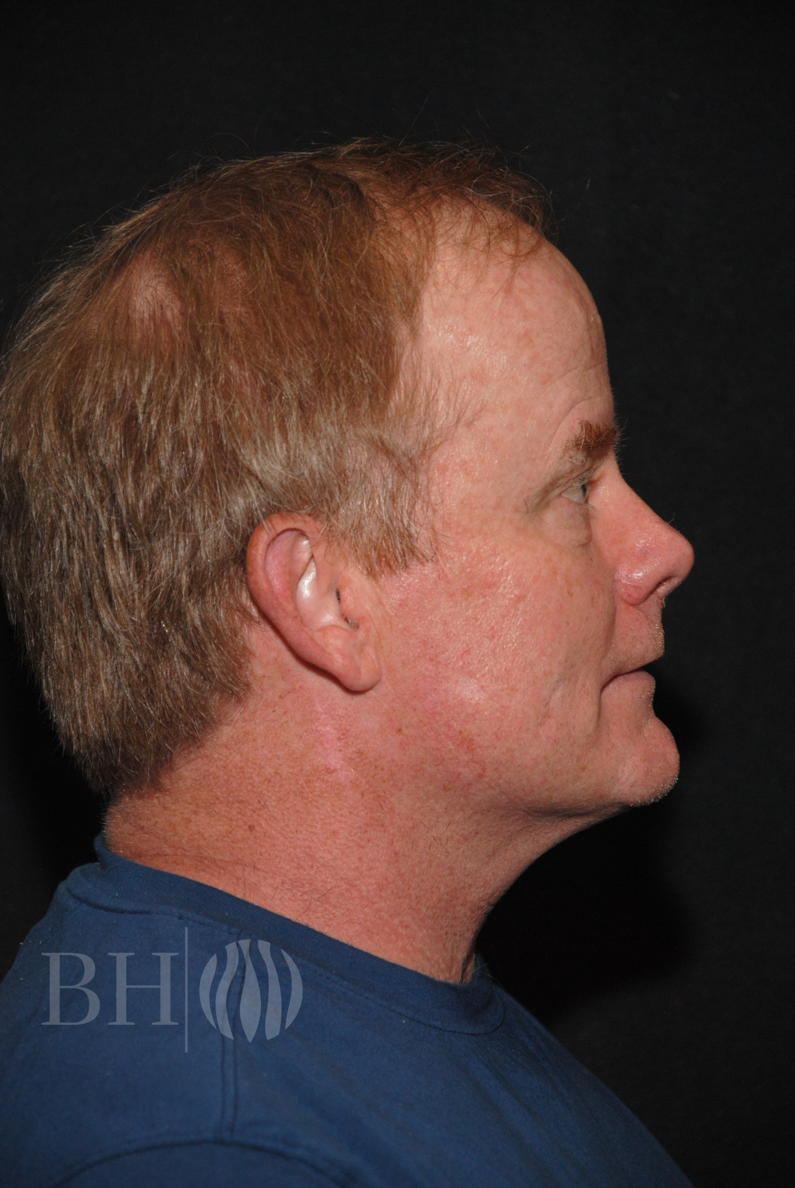 Neograft hair Before and After